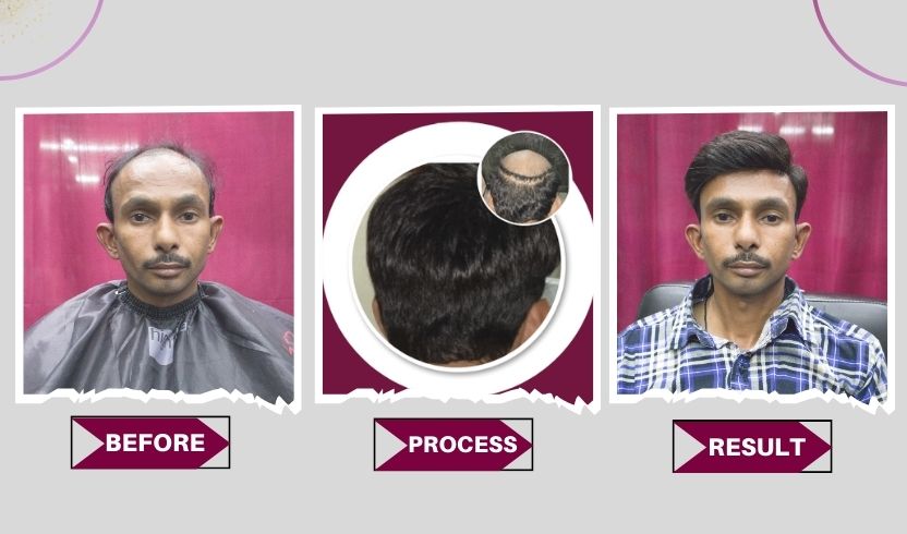 hair Weaving Service process, Hair weaving Service near me, Hair weaving service for men, Hair Weaving Service in Delhi, Hair weaving service price